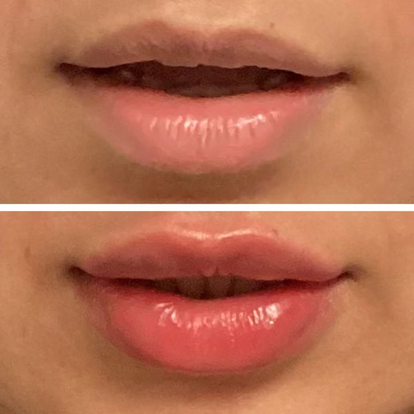Lip Filler Before and After 1