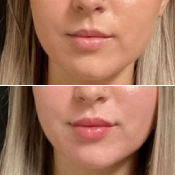 Lip Filler Before and After 10
