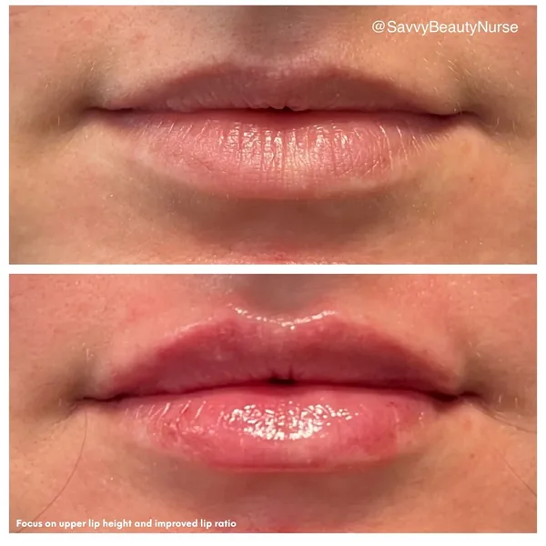 Lip Filler Before and After 4