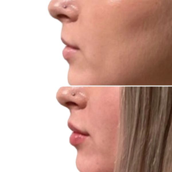 Lip Filler Before and After 5