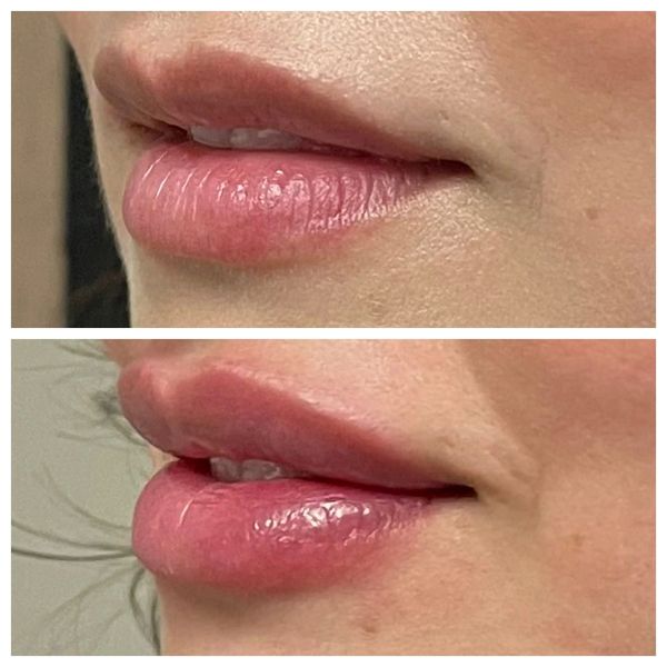 Lip Filler Before and After 7