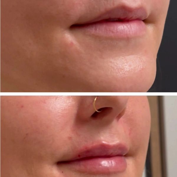 Lip Filler Before and After 8