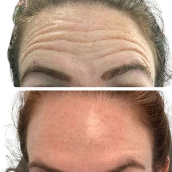 Wrinkle Relaxers Before and After 7