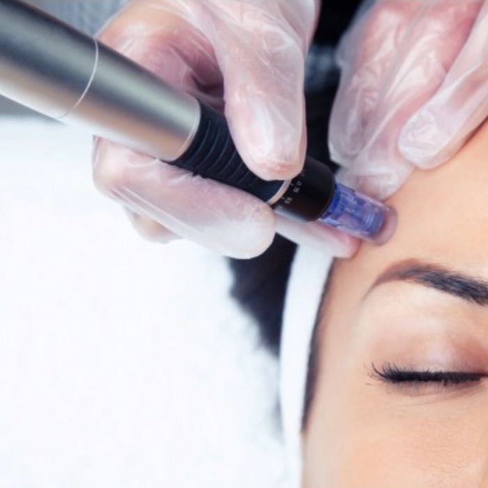 Skin-Care-Services-Microneedling