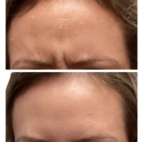 Before and After Wrinkle Relaxers
